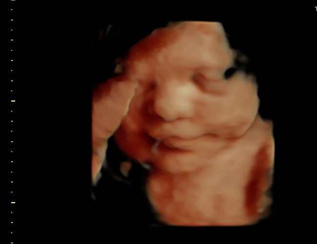 3D ultrasound image at 31 weeks